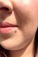 Neometal lip